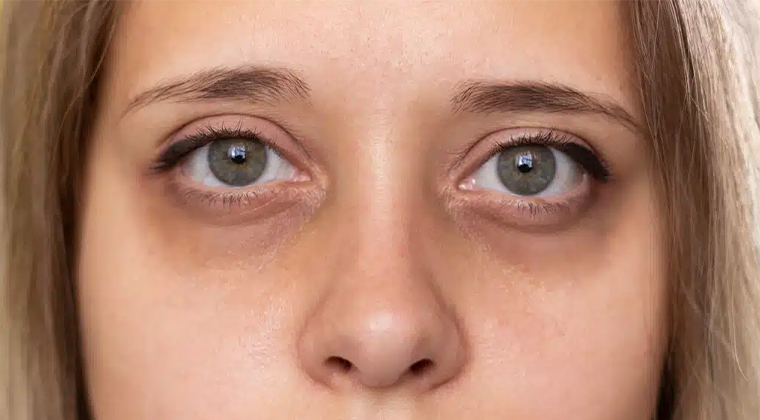 Ojeras